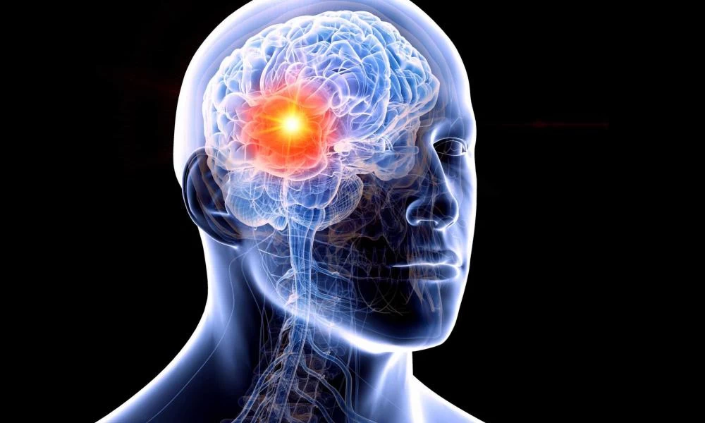 Σημαντική ανακάλυψη για την θεραπεία του καρκίνου του εγκεφάλου